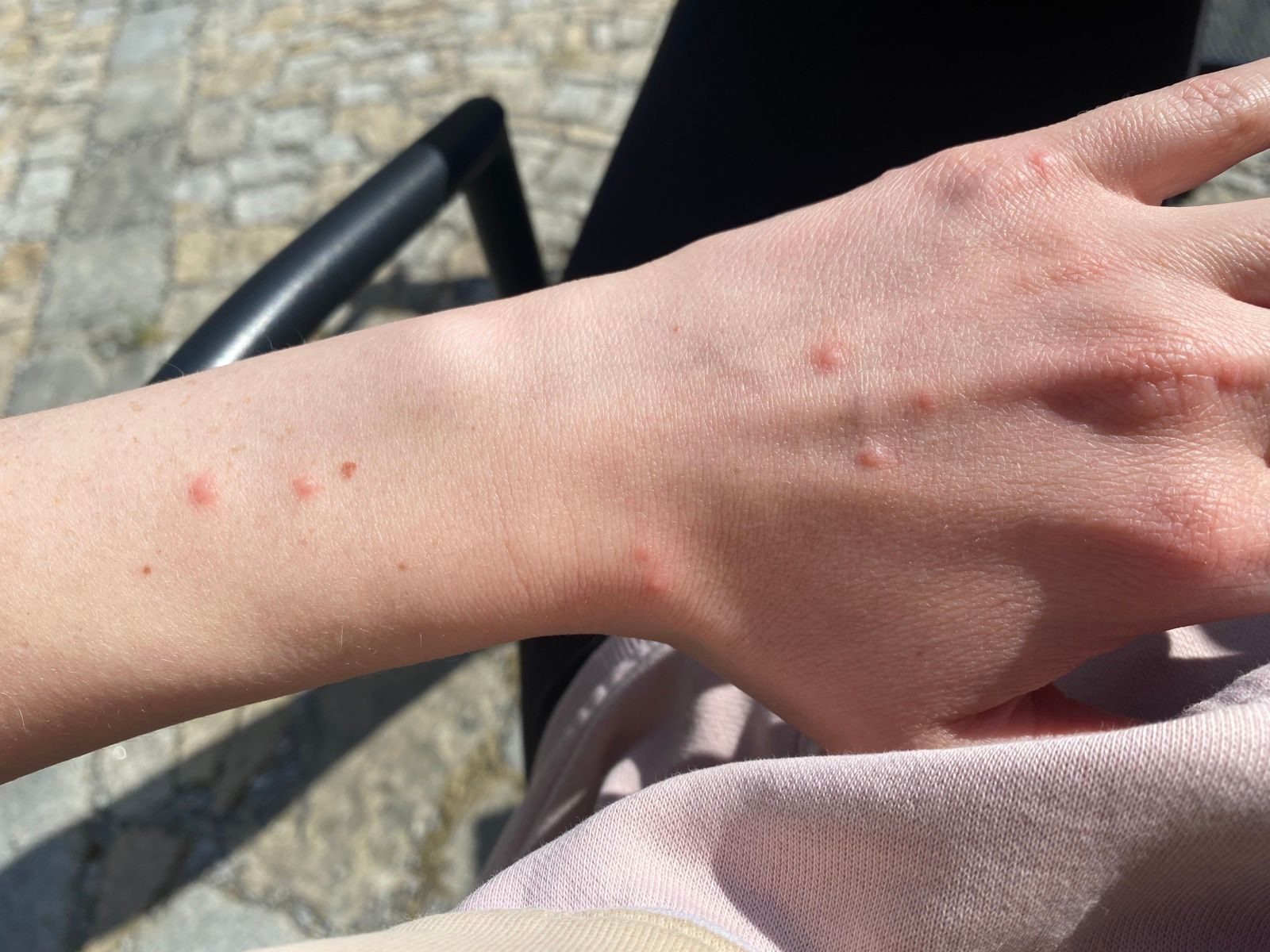 006: jak vypadá kousnutí štěnice