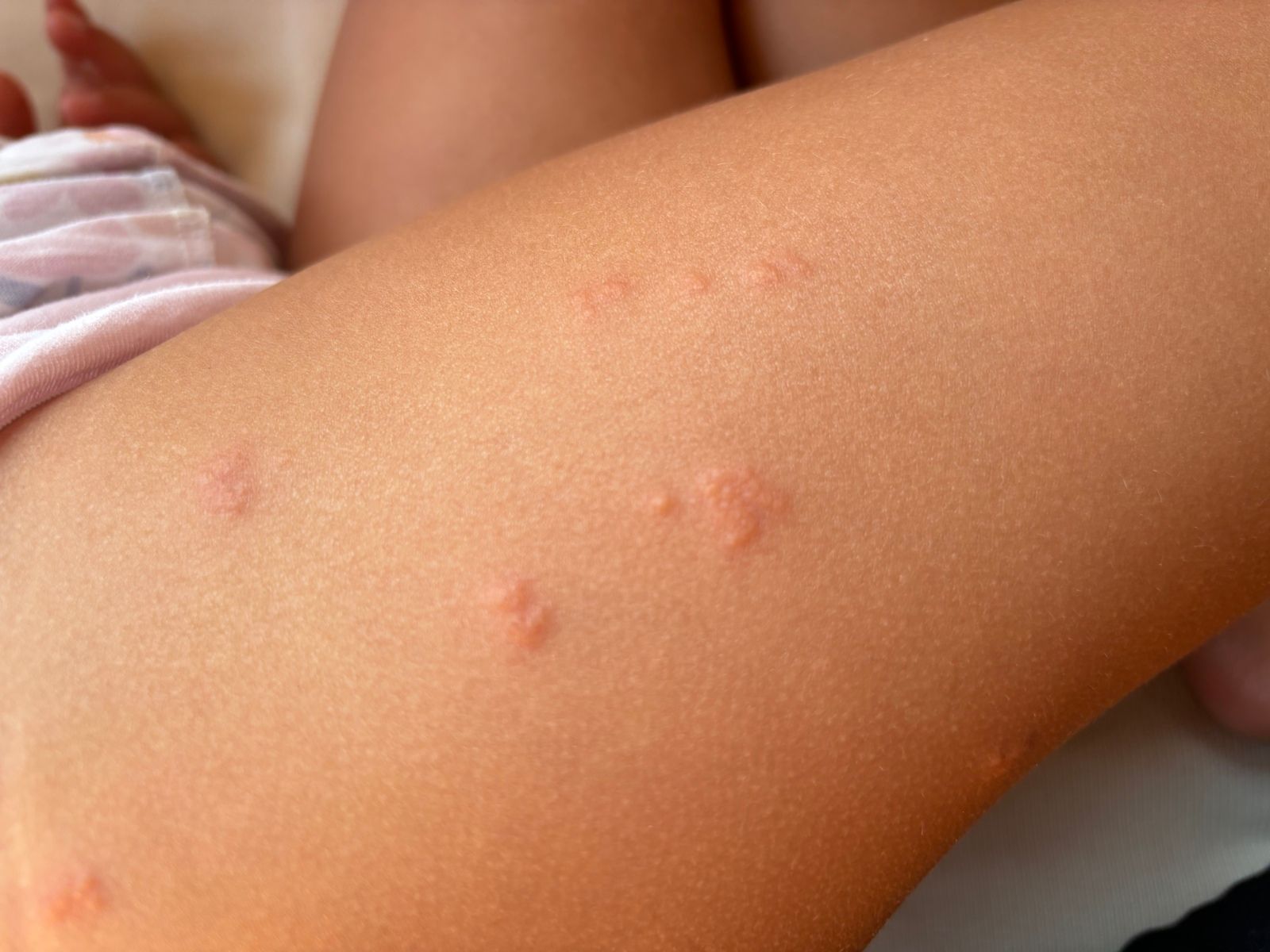 001: kousnutí od štěnice foto