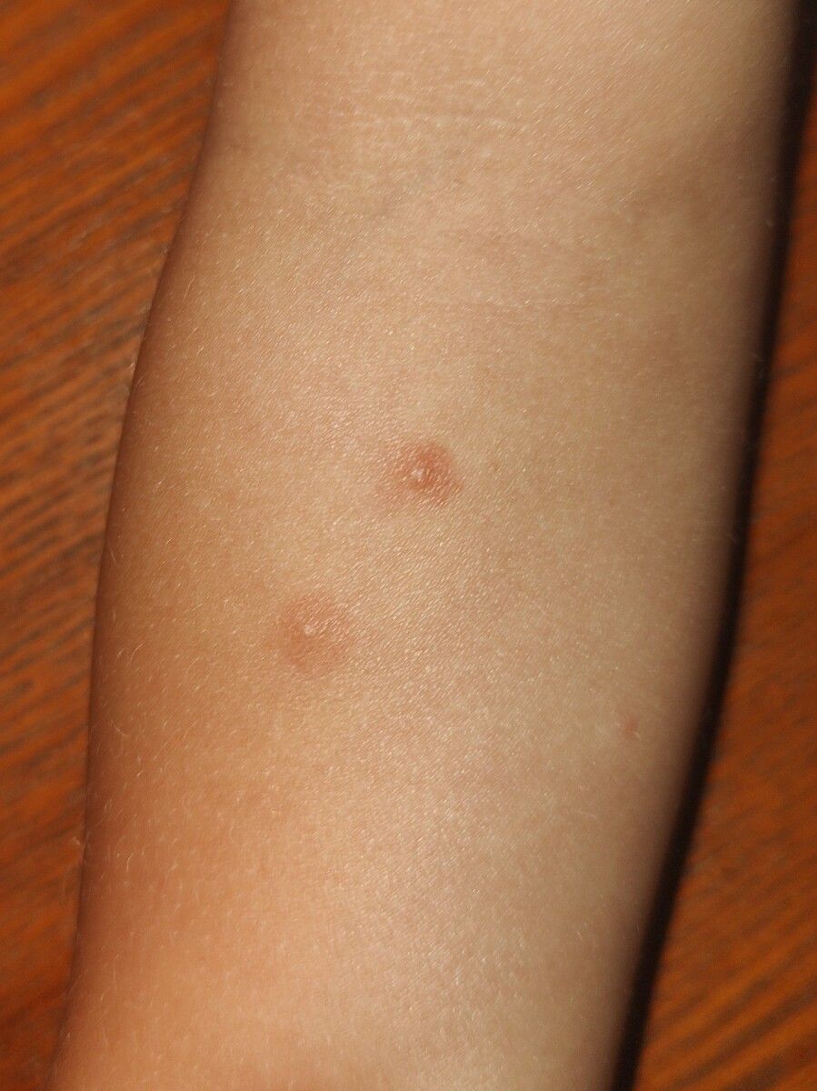 003:
pokousání od štěnice na ruce